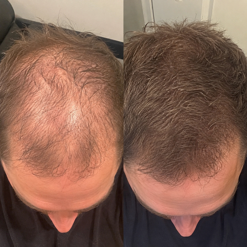 Excalvo Cápsulas Clínicas de Crecimiento del Cabello