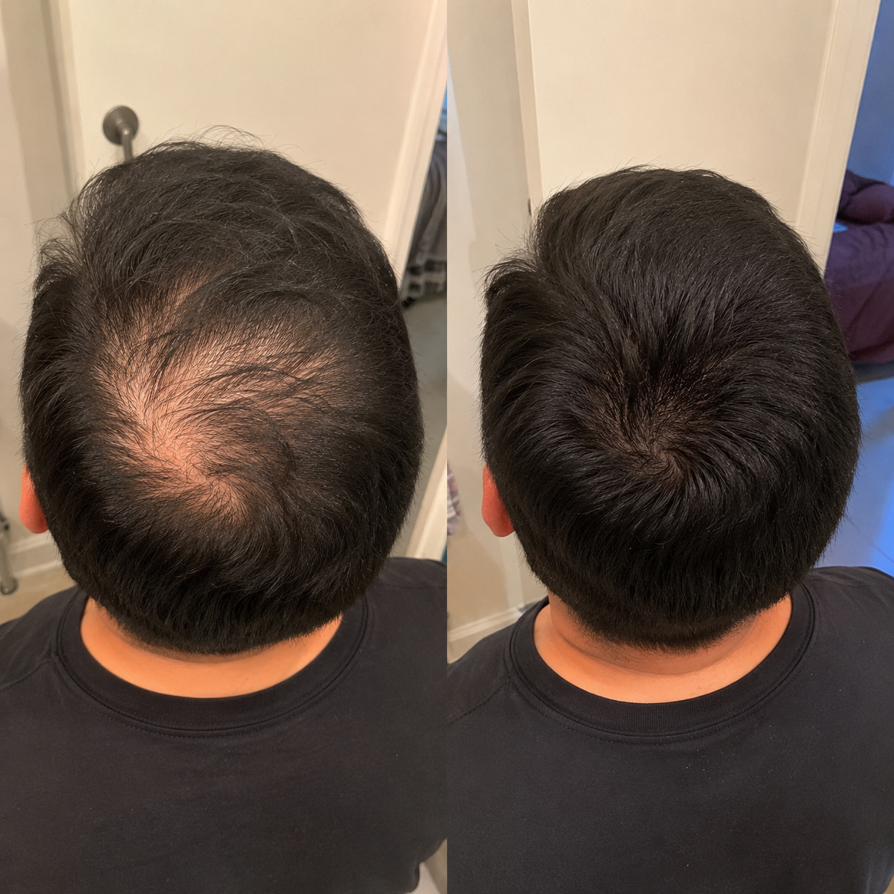 Excalvo Cápsulas Clínicas de Crecimiento del Cabello